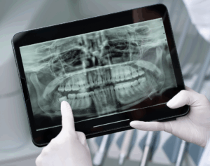 Dental X-Ray
