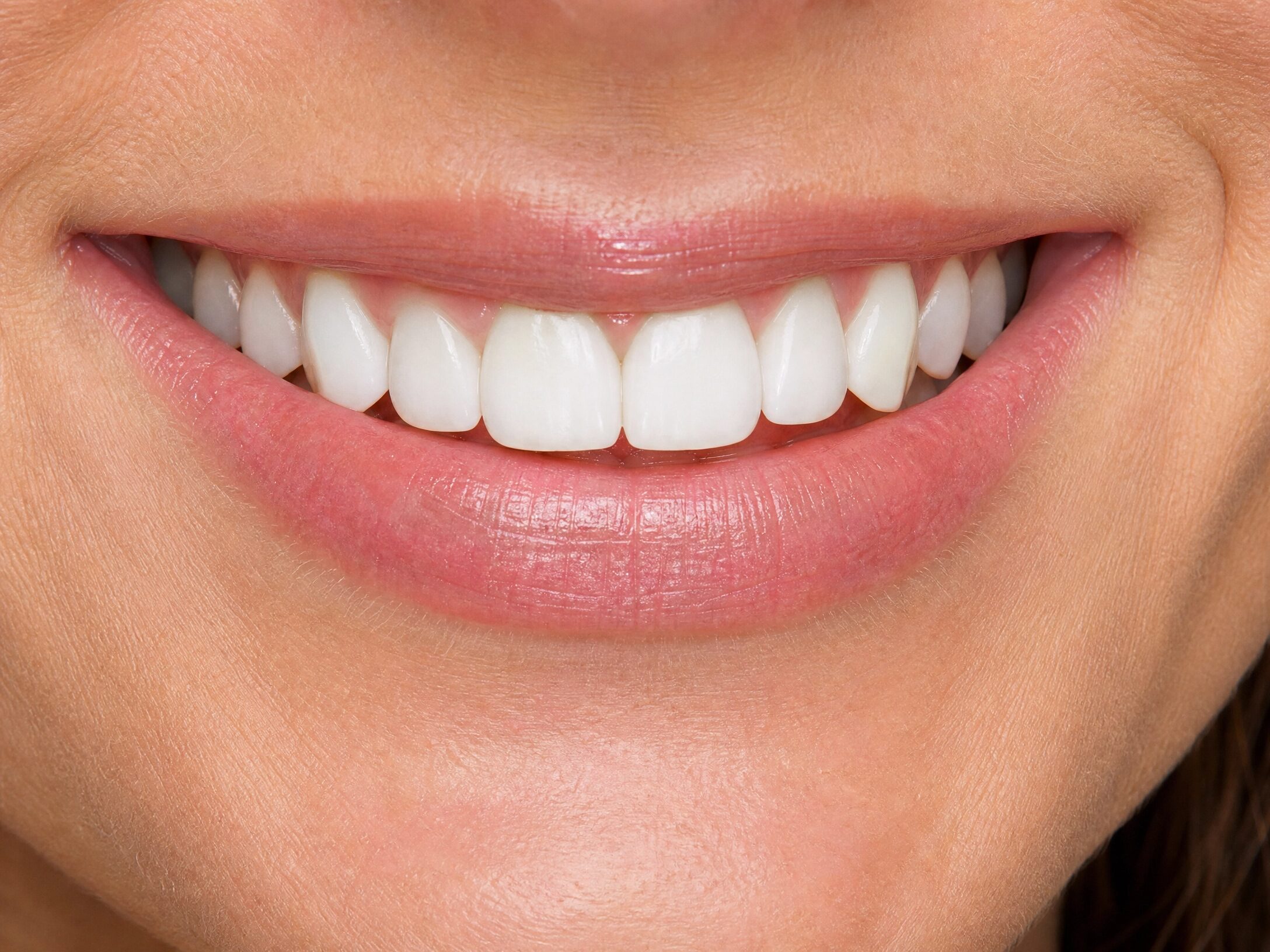 Restored smile after dental implant treatment