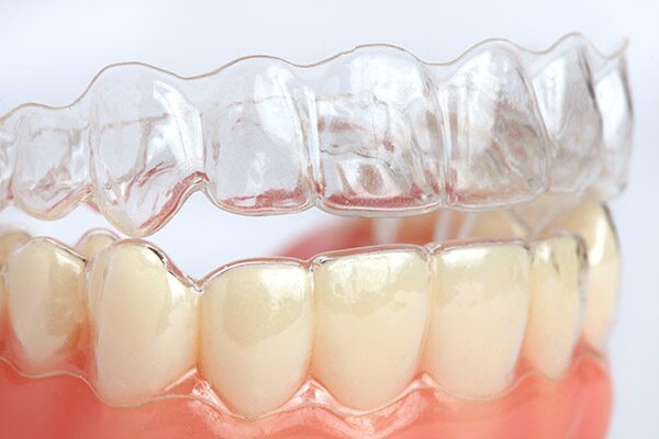 Invisalign clear aligners on teeth model - Centerville Dental Center, OH