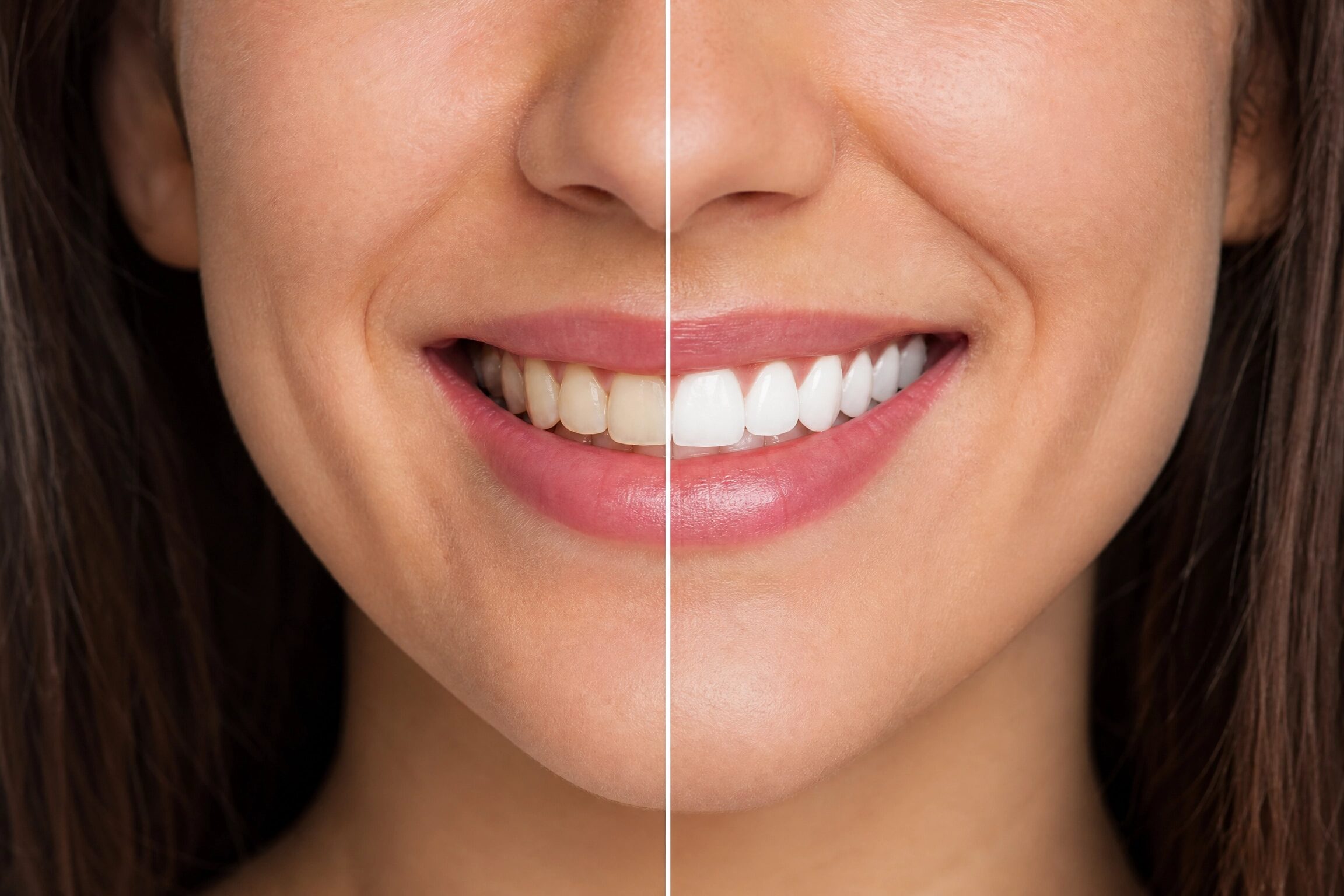 Teeth whitening before and after results showing dramatic improvement at Centerville Dental Center