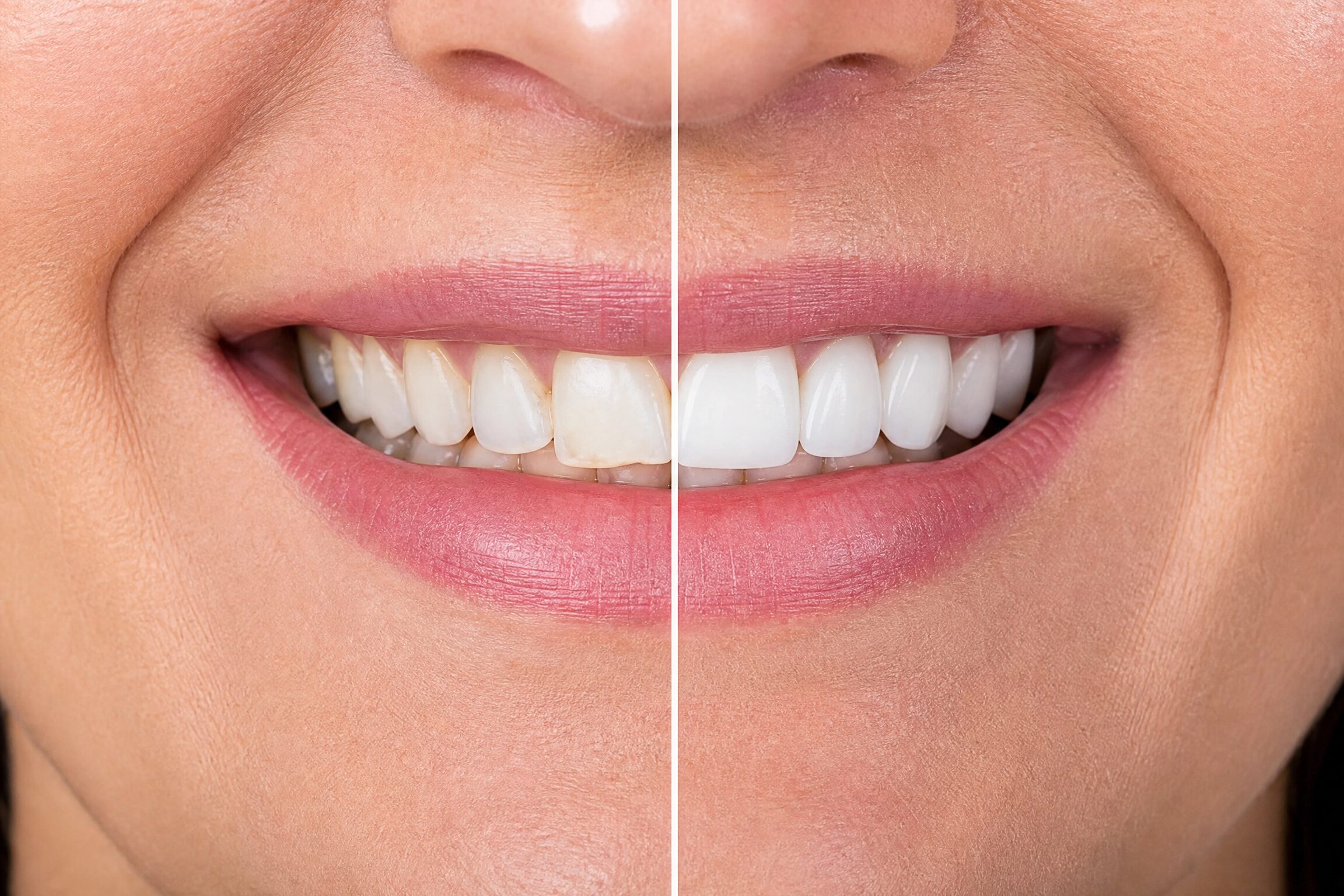 Before and after porcelain veneers smile transformation at Centerville Dental Center in Centerville Ohio