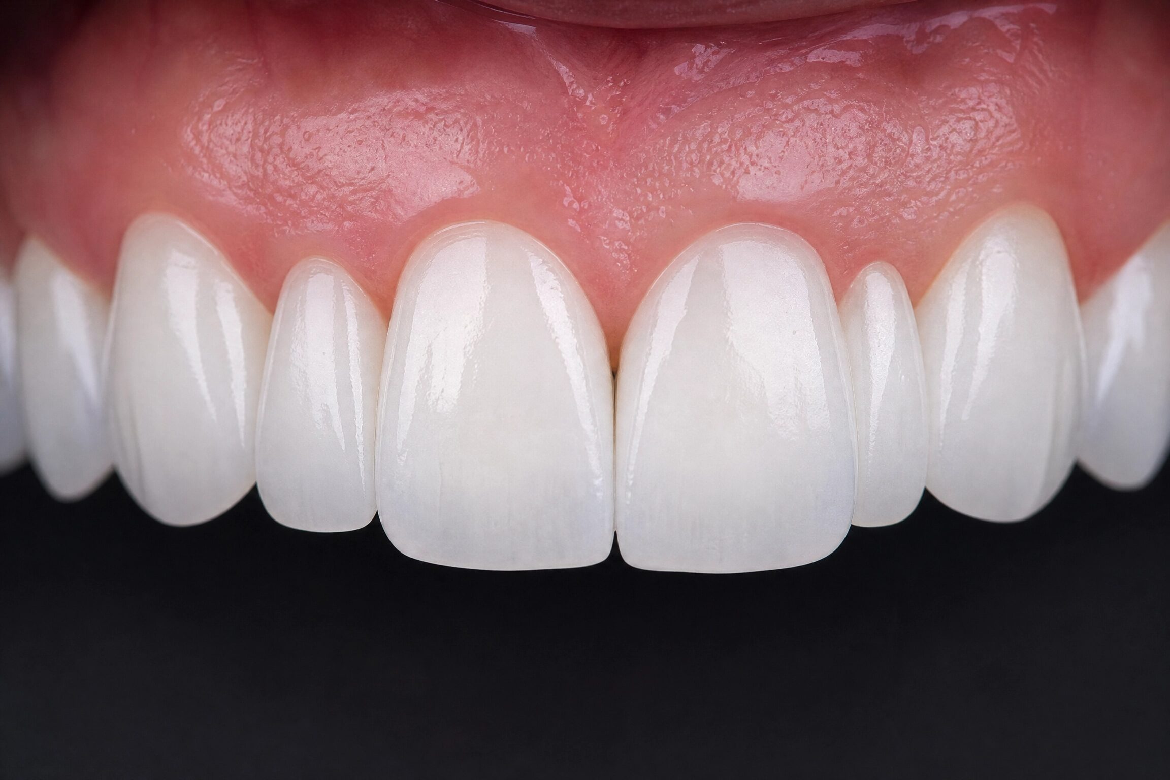 Close-up of ultra-thin natural-looking porcelain veneers crafted at Centerville Dental Center